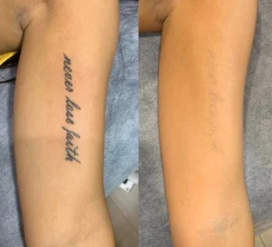 Laser Tattoo Removal
