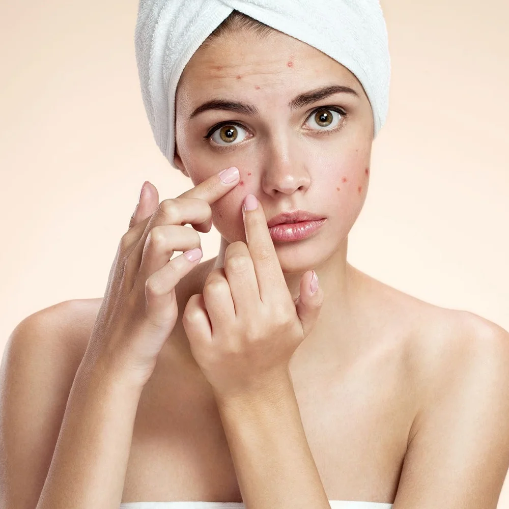 Acne Facial Treatment