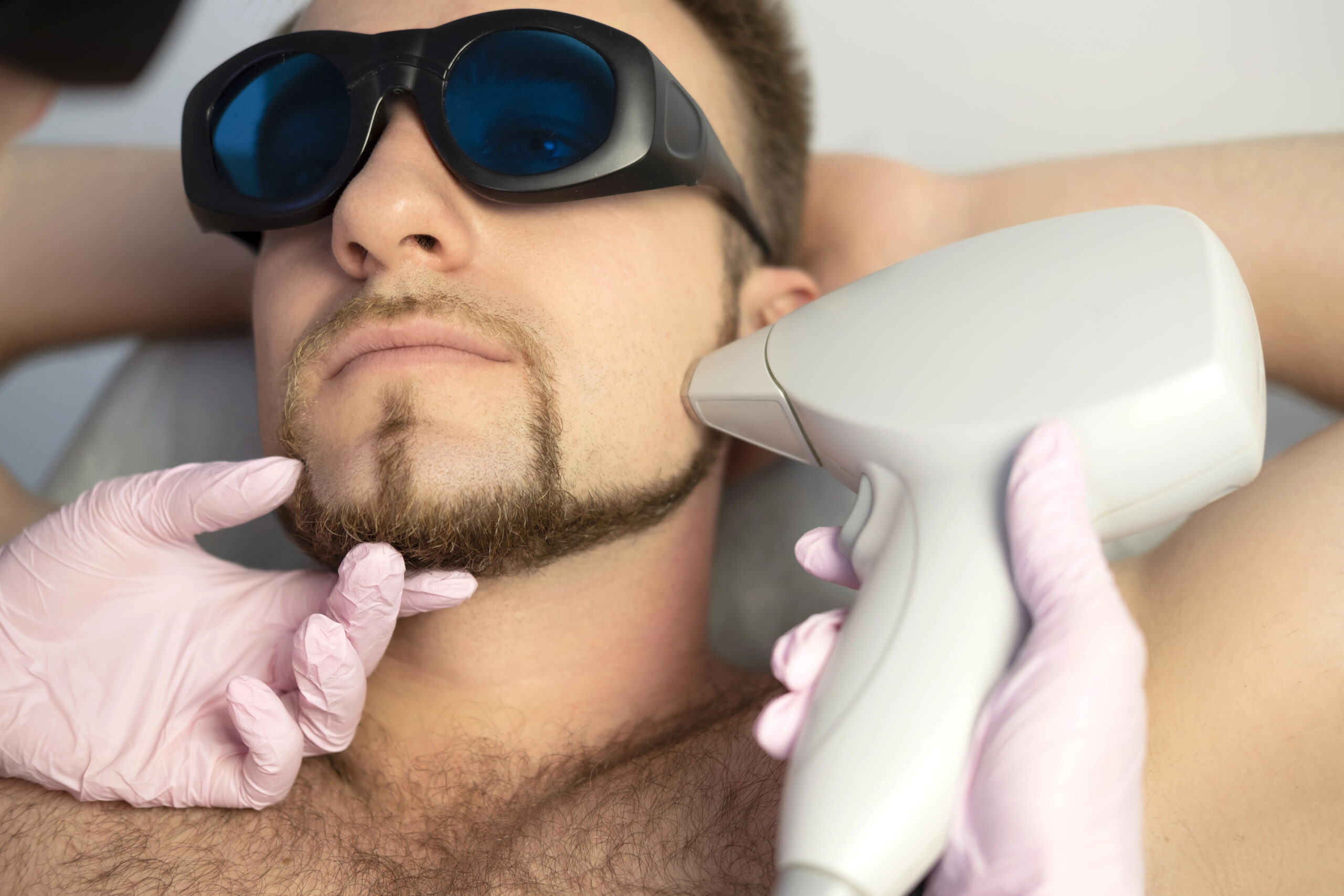 Men's facial laser hair removal for a clean, groomed look and reduced beard irritation.