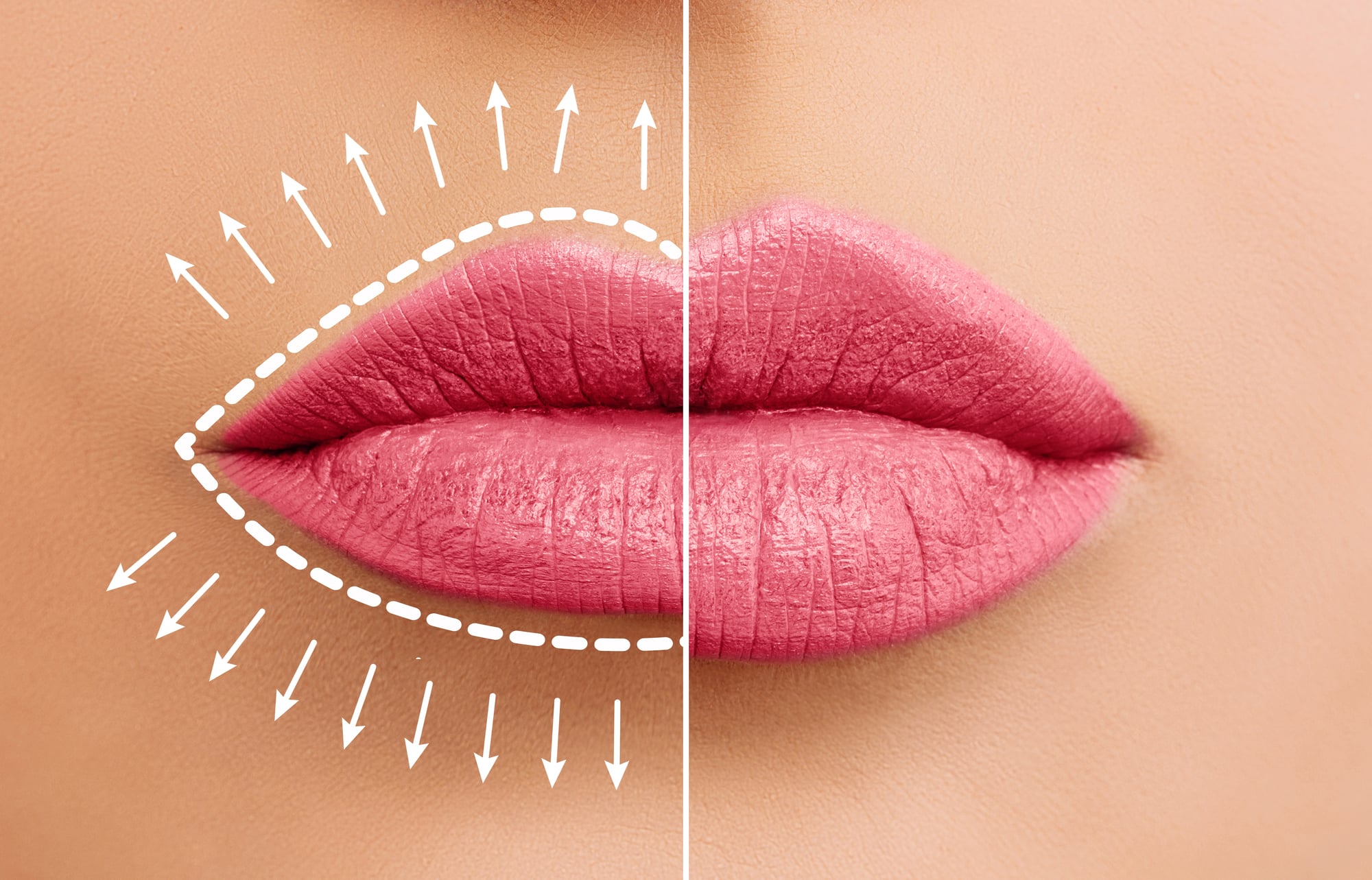 Educational infographic showing lip anatomy and how fillers enhance the cupid's bow and vermillion border